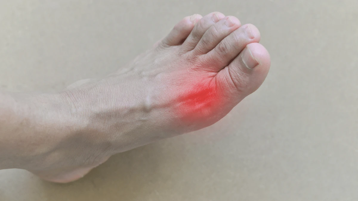 symptoms of gout in the legs